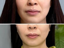 ハス(hasu.)/フェイスラインスッキリ