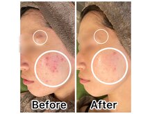 ドクタースキン(Dr.skin)の雰囲気（肌質改善機械とハーブピーリングbefore  after【ニキビケア】）