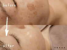 ボウ 静岡本店(VOEUX)/20代　シミケア　8回