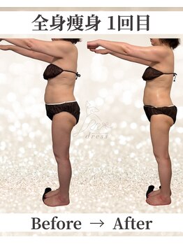 ドレス(dress)/全身痩身Before/After
