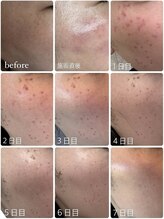 【シミケア後のダウンタイムは？】