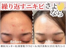 シー センター北(sii)/敏感肌の肌質改善はララピール