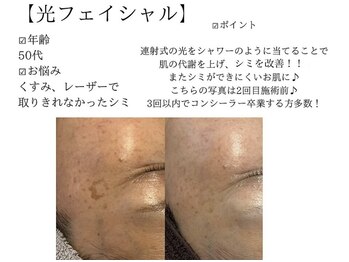サロンツキ(salon tuki)/光フェイシャル症例★徳島