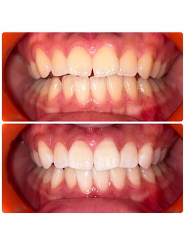 コナホワイトニング 神保町/セルフホワイトニング神保町