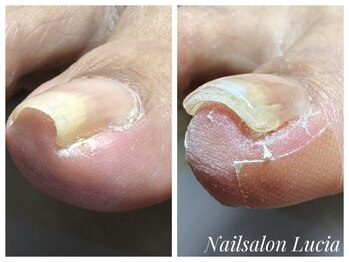ネイルサロンルキア(Nail salon Lucia)/【巻き爪補正】ペディグラス補正