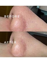 カウニス るる(kaunis)/【ララピール】Before After