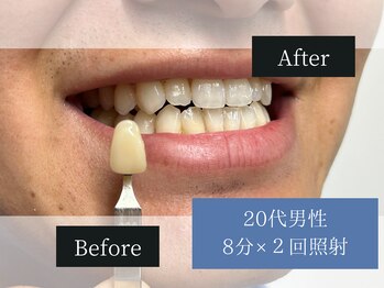 ホワイトニングカフェ 札幌大通店(WhiteningCafe)/◎歯のホワイトニング施術写真◎