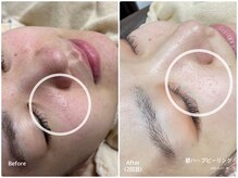 ラウレア(LAULEA)/ハーブピーリングBefore/after