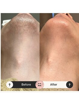 トレテル/メンズヒゲ脱毛