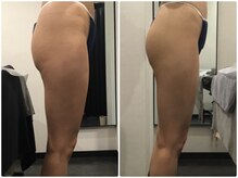 フィックスユー ビューティー(Fixyou BEAUTY)/脂肪冷却　before after