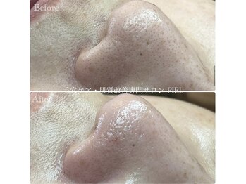 ピエル 北千住店(PIEL)/エクストラクションとは