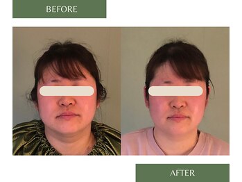 凛/若よもぎ蒸し　Before/After