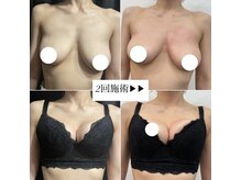 ソワ(soie)の雰囲気（30代前半/出産経験なし/左右差/ふんわりデコルテ/下垂/ハリ）