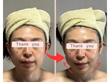 リセル(Recell)/小顔☆脂肪分解