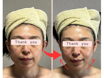 リセル(Recell)/小顔☆脂肪分解