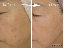 ボウ 静岡本店(VOEUX)/50代　シミケア15回