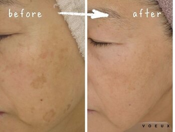 ボウ 静岡本店(VOEUX)/50代 シミケア15回