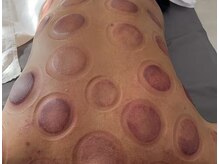 楽美/カッピング施術後