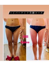 キャルム/ハイパーナイフ美脚コース