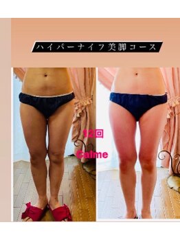 キャルム/ハイパーナイフ美脚コース
