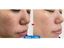 プルメリア(Plumeria)の雰囲気（【最新機器スウェルスキン】毛穴、シミケアに効果絶大★）