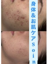 ソアン(Soin)/ハーブピーリング剥離なし