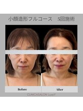 リュクシー(LuxeY)/50代小顔造形フルコース 5回施術