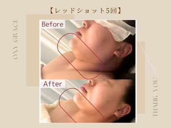 オキシー グレイス 小倉店(OXY Grace)/レッドショット5回