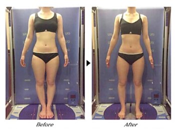 ビューティークリニックコダマ 延岡店/【2ヶ月コース】M.K様(21歳)