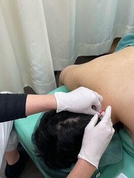 げんき堂整骨院 げんき堂鍼灸院 御徒町/首の張りに刺激を!