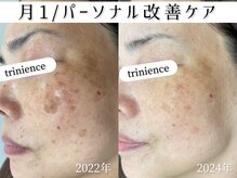 トリニエンス 新宿店(TRINIENCE)/50代/シミケア/パーソナルケア