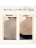 モニター様【背中(上部)ケア】松ヤニワックス×REVIハーブピーリング16,980円