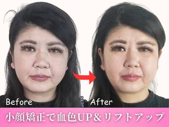 ワト(WATO)/■小顔施術(before→after)