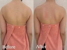 カレンジェビューティー(CarengeBeauty)/背中デザインコース