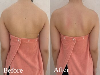 カレンジェビューティー(CarengeBeauty)/背中デザインコース