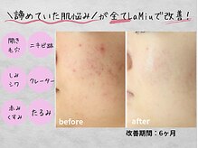 ラミーユ(La Miu)の雰囲気(繰り返す肌荒れや気になる肌荒れ跡を改善◎赤み改善)
