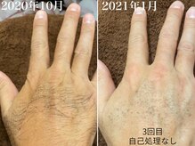 ラブ美長寿 沖縄本店(Lab)/【ビフォーアフター】メンズ脱毛