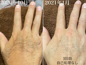 ラブ美長寿 沖縄本店(Lab)/【ビフォーアフター】メンズ脱毛