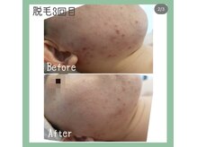 スタジオコノハ(studio508 konoha)/顔脱毛