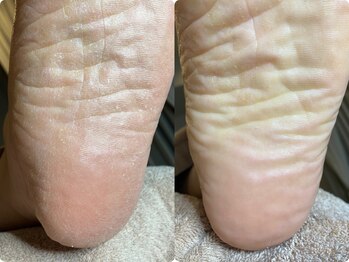 メグムサロン(Megumu Salon)/足つぼ/角質/マッサージ