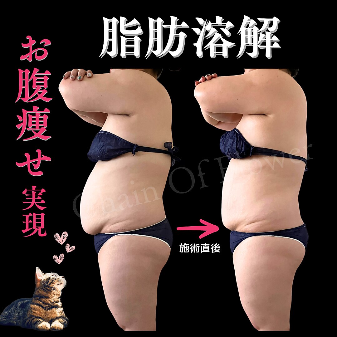 ハイパーナイフ全身120分コース1回でスッキリ｜private salon