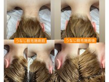 るあん/美肌脱毛