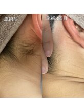 サロンリアンジュ ひたちなか店(Salon Liange)/うなじ脱毛◇目指せうなじ美人