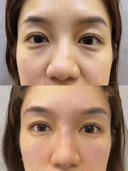 美リレア/最新ヒト幹細胞培養液導入コース