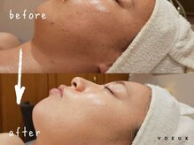 ボウ 静岡本店(VOEUX)/20代　顎ニキビ　10回