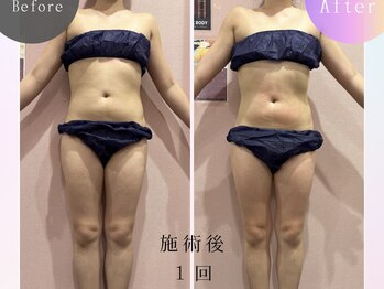 ルピナス ヒサヤ(LUPINUS hisaya)/Vシェイプ痩身