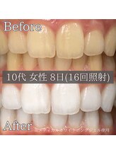シカホワイトニングトウキョウ 笹塚店(CICA Whitening Tokyo)/ビフォーアフター（10代女性）