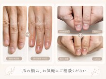 スティラ Stila 678の雰囲気（《深爪矯正》施術写真 https://ameblo.jp/stila678-2021/   ）