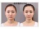 幸永院 川口店の写真/短時間一度でも驚きの激変！たるみ,むくみ,歪み,エラ,ほうれい線,面長,丸顔改善♪サイズ&美肌変化に驚愕！
