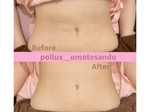 ポルクス鍼灸整骨院 表参道(Pollux鍼灸整骨院)/インディバ　ダウダウンタイム